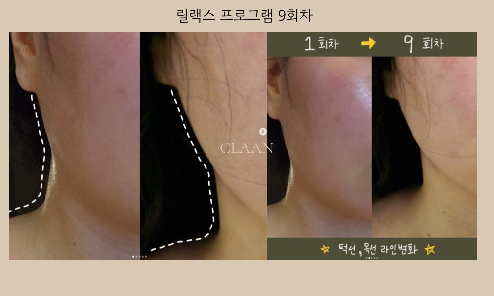 몸은 창피해서 달라진 턱선 라인 인증 :-) 